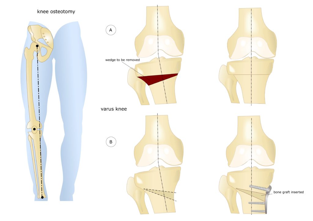 Остеотомия коленного сустава