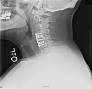 Импланты шейного отдела позвоночника на рентгене.
