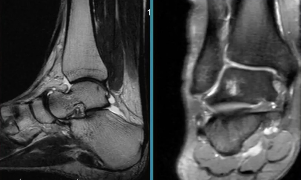 Артрит голеностопа на МРТ.