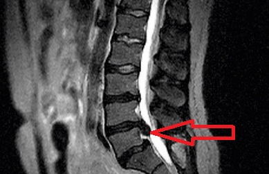 Грыжа поясничного отдела с тяжелым стенозом