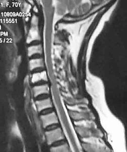 Грыжа шейного отдела на МРТ