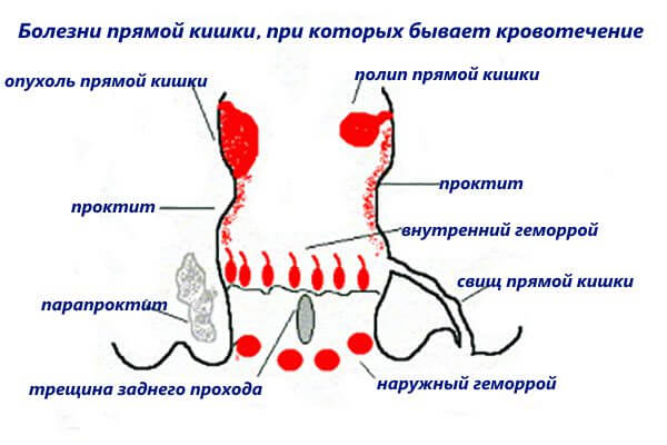 Болезни прямой кишки, провоцирующие кровотечение из заднего прохода