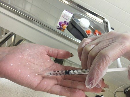 Ботокс при повышенной потливости ладоней