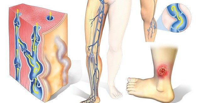 Что такое трофическая язва