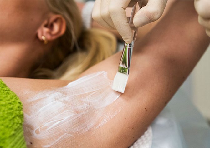 Диагностика гипергидроза