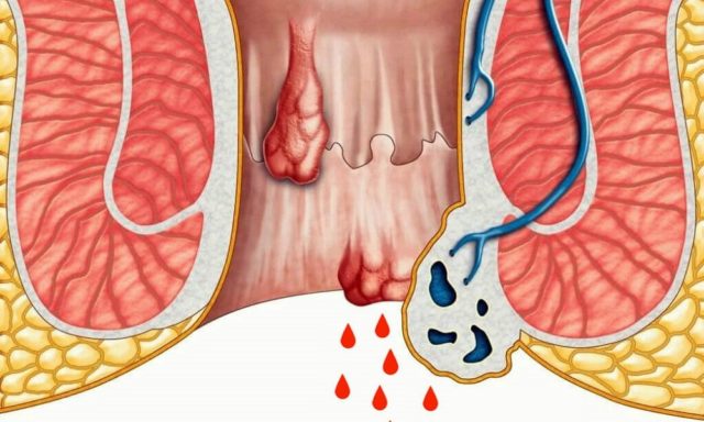 для чего нужны геморроидальные узлы