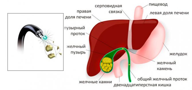 дробление камней лазером