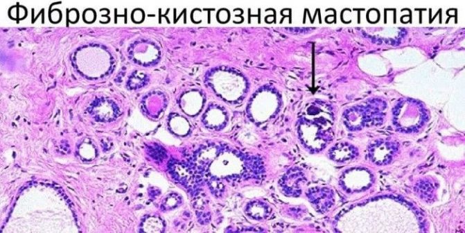 фиброзно-кистозная форма