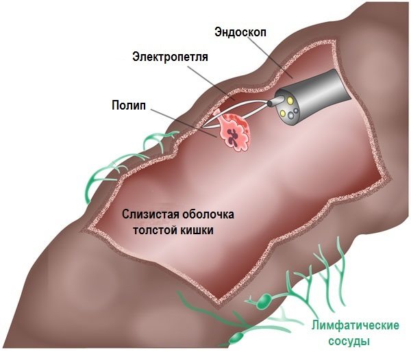 Форлакс для очищения кишечника. Отзывы, инструкция перед колоноскопией, рентгеном, при грудном вскармливании