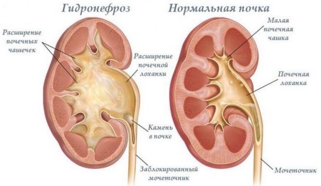 Гидронефроз почек