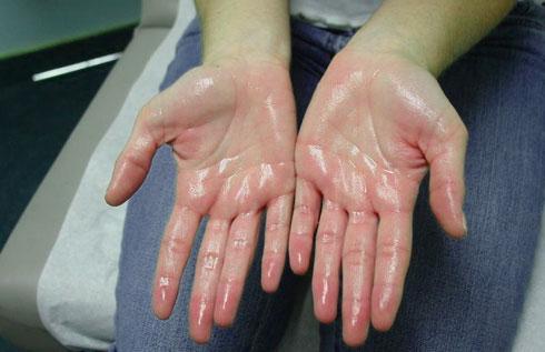 Гипергидроз ладоней