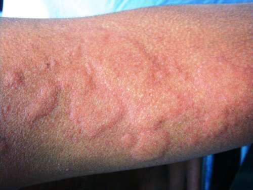 Холодовая форма крапивницы