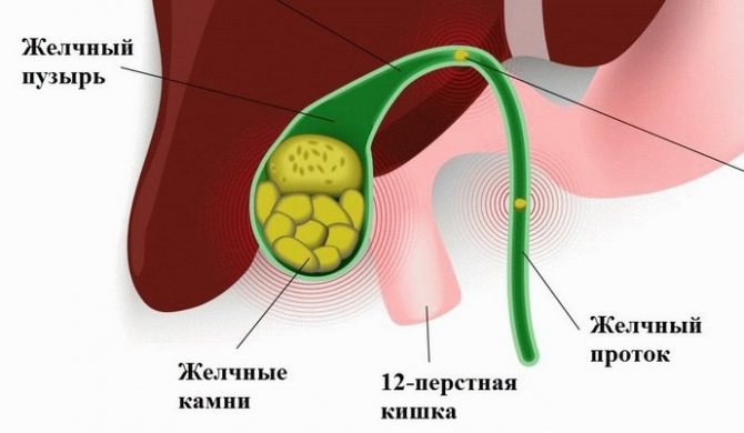 Камни в желчном пузыре встречаются у очень большого количества людей.