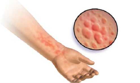 крапивница у взрослых