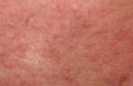 крапивница