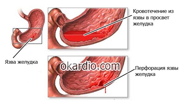 кровотечение из язвы желудка