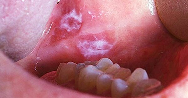 лечение язв в стоматологии