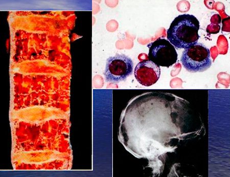 Метастазы лейкозов в кости и картина крови при них