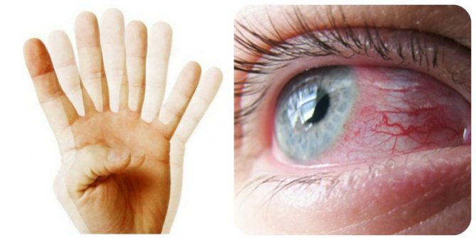 Нечеткое зрение, двоение в глазах