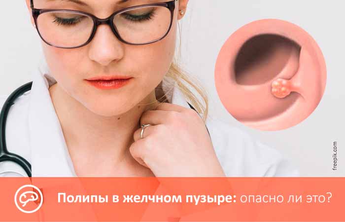 Опасно ли иметь полипы