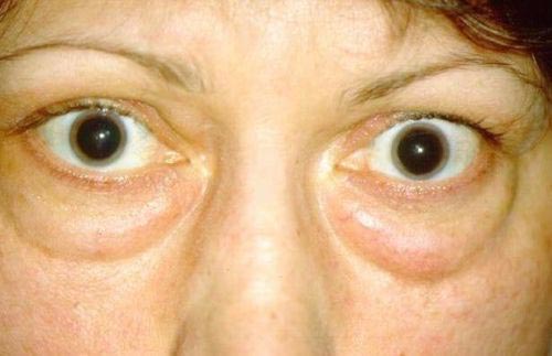 отечный экзофтальм