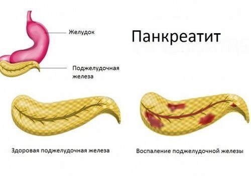 Панкреатит