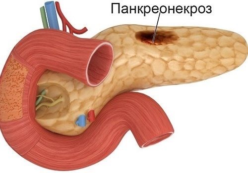 Панкреонекроз