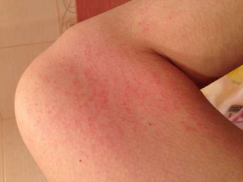 Покраснение на коже