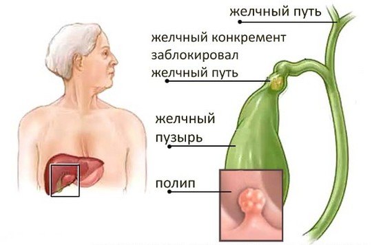 Полипоз желчного пузыря
