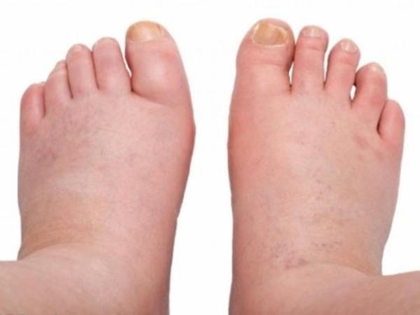 Причины, диагностика и лечение почечных отеков