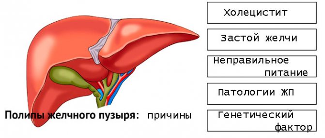причины полипов в желчном