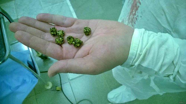 Разбить камни в желчном пузыре ультразвуком