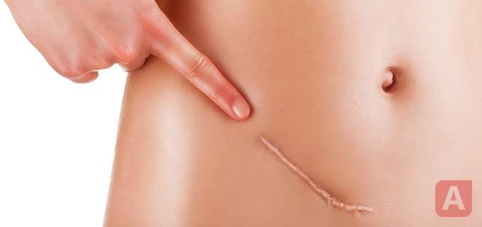 Шрам от аппендицита