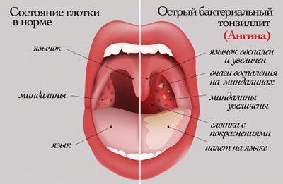 Симптомы ангины