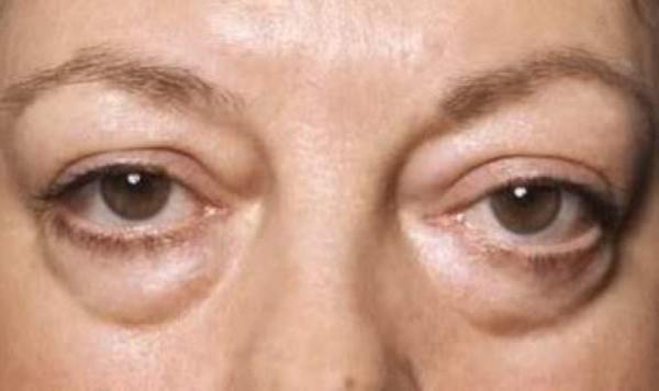 Симптомы и механизм развития отеков почечного происхождения