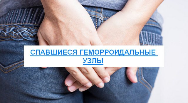 спавшиеся геморроидальные узлы что это