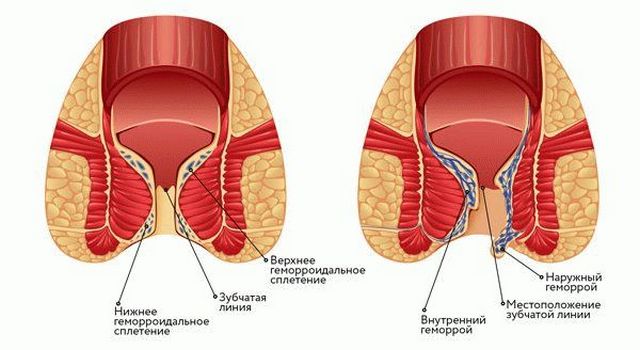 спавшиеся геморроидальные узлы