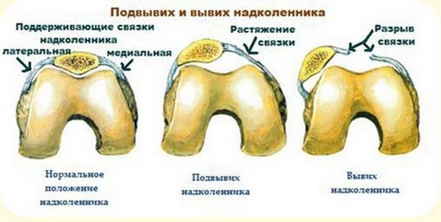 Травма колена, мениска: симптомы, признаки, лечение