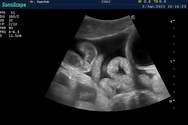 УЗИ кишечника