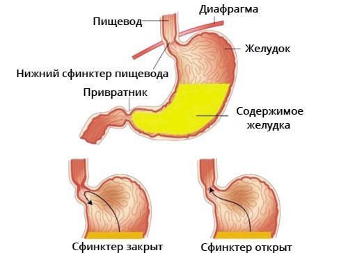 Желчь в желудке - причины, лечение после удаления желчного пузыря